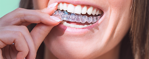 ferula transparente corrector transparente ortodoncia brackets Clinica Dental en Fuengirola